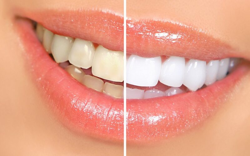 How Long Does It Take to Whiten Your Teeth